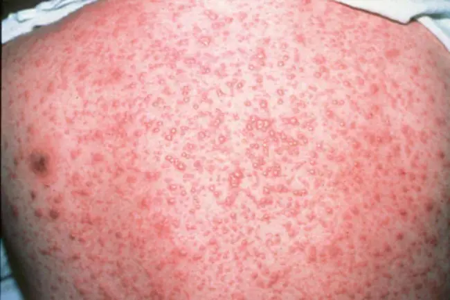 Varicella Zoster Immune Plasma : 水痘带状疱疹免疫血浆