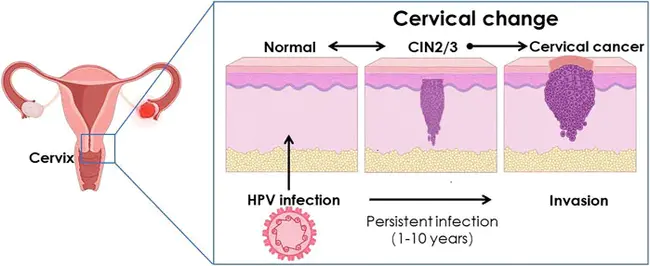 Cervical Human Papillomavirus Infection : 宫颈人乳头瘤病毒感染