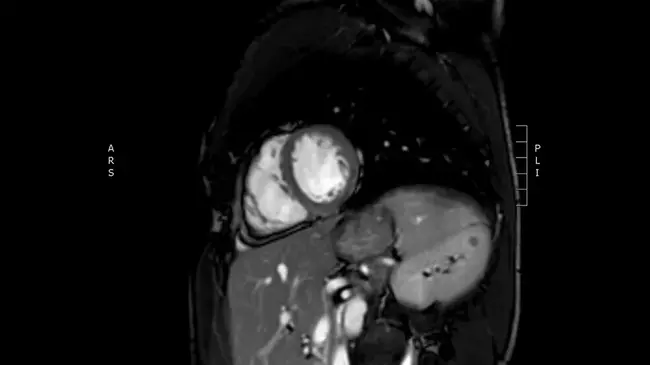 Arrhythmogenic Right Ventricle Cardiomyopathy : 心律失常性右心室心肌病