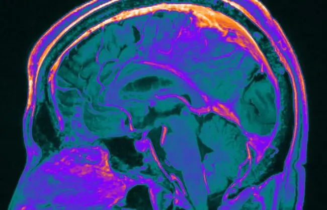 Regional Brain Glucose Utilization : 区域脑葡萄糖利用