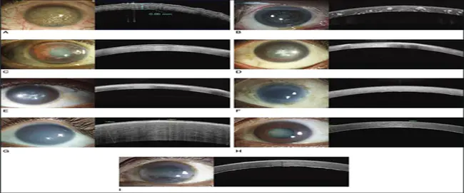 Corneal Dystrophy and Perceptive Deafness : 角膜营养不良与感觉性耳聋