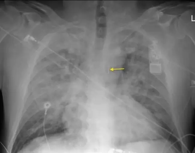 Intra-Aortic Balloon Occlusion : 主动脉内球囊闭塞