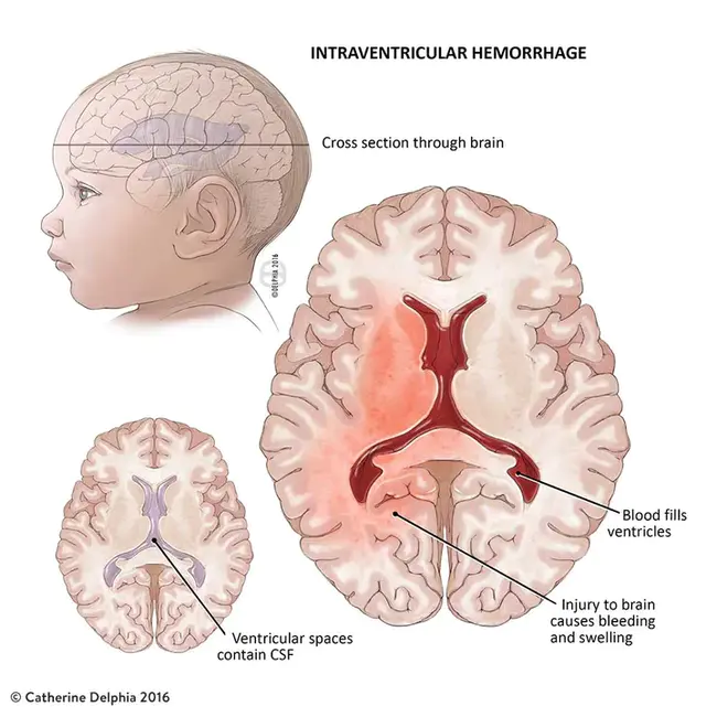 Intra-Ventricular Conduction Defect : 心室内传导缺损