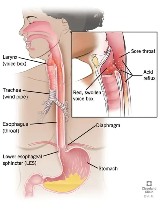 LaryngoPharyngeal Reflux Disease : 喉咽反流病