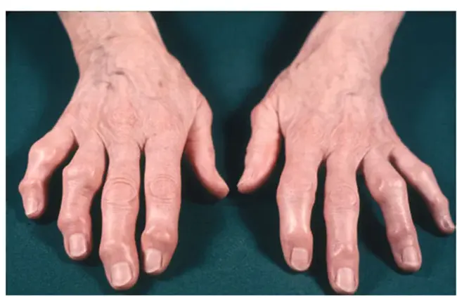 Proximal Inter-Phalangeal Joint : 指骨间近端关节