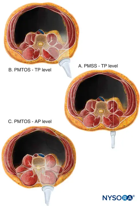 Paravertebral Somatic Nerve Block : 椎旁体神经阻滞