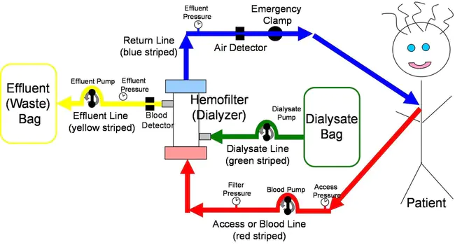 Continuous Veno-Venous Hemofiltration : 连续静脉血液滤过