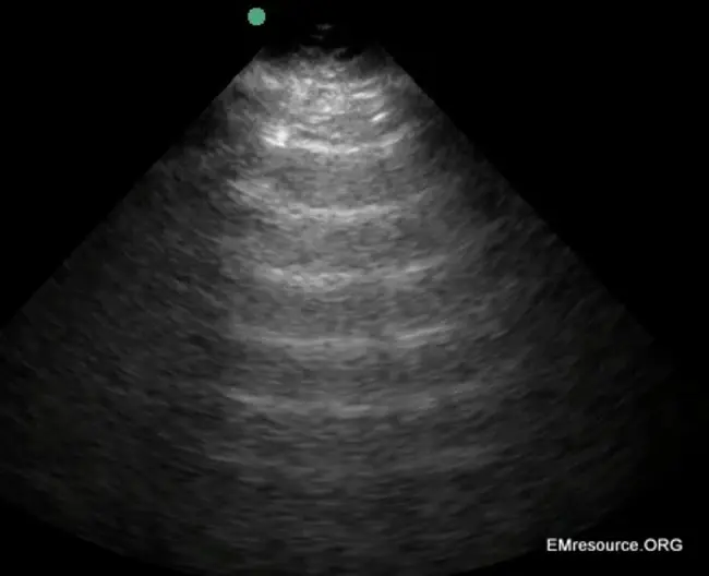 Air Contrast Ultrasonographic Venography : 空气对比超声静脉造影