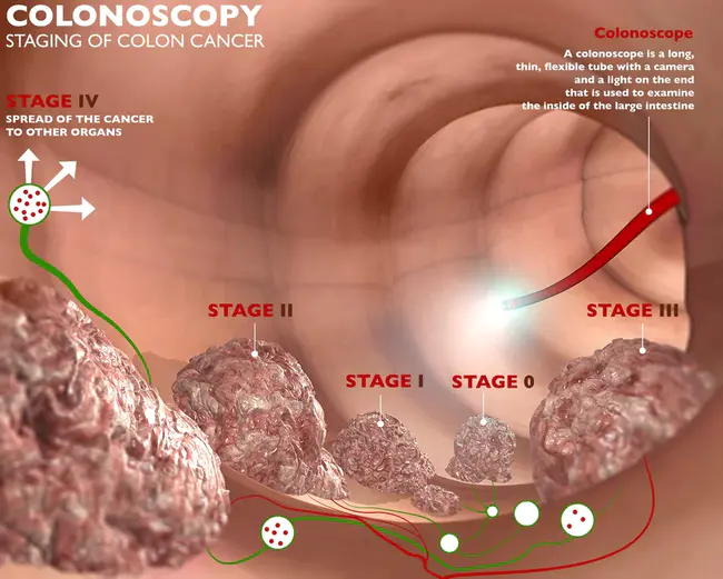 Colon Recontruction Applying Circulatory Kare : 应用循环kare重建结肠