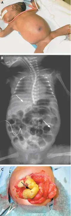 Necrotizing Ulcerative Gingivitis : 坏死性溃疡性牙龈炎