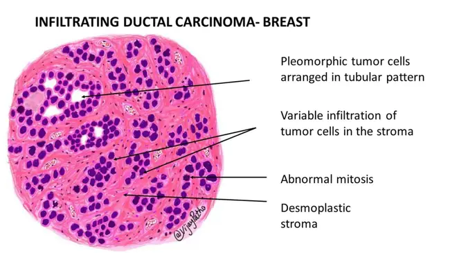 Breast Carcinoma : 乳腺癌