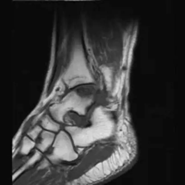 Osteochondritis Dissecans : 剥脱性骨软骨炎