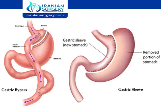 Duodenal Switch : 十二指肠转位手术