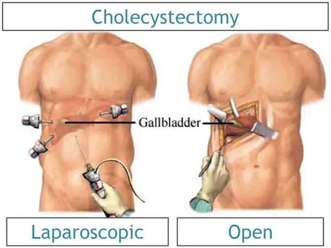 CholeCYstectomy : 胆囊切除术