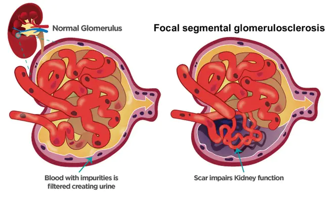 Focal Segmental Glomerulosclerosis : 局灶性节段性肾小球硬化