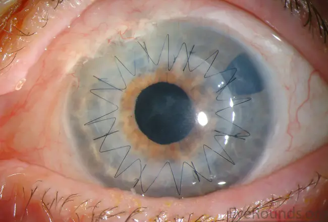 Penetrating Keratoplasty : 穿透性角膜移植术