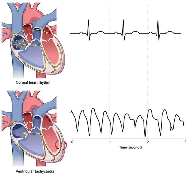 Ventricular Tachycardia : 室性心动过速