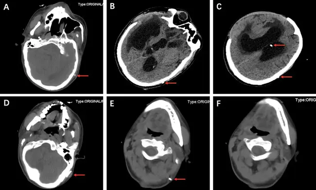 IntraParaVentricular Nucleus administration : 脑室旁核给药