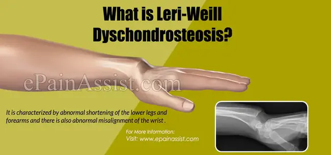 Leri-Weill Dischondrosteosis : 勒里-威尔椎间盘突出症