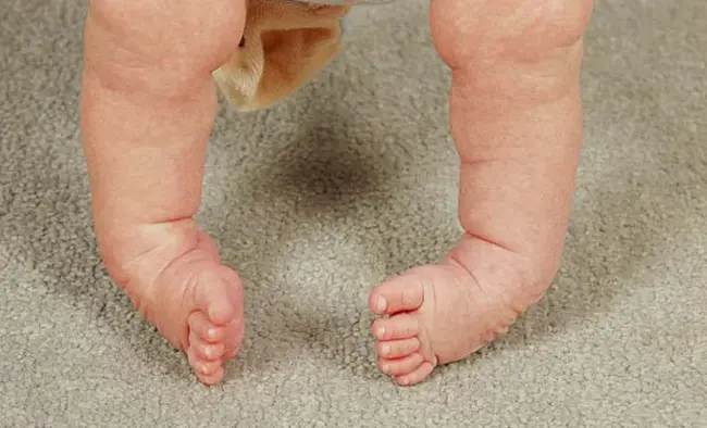 Clubfoot Syndrome : 马蹄内翻足综合征