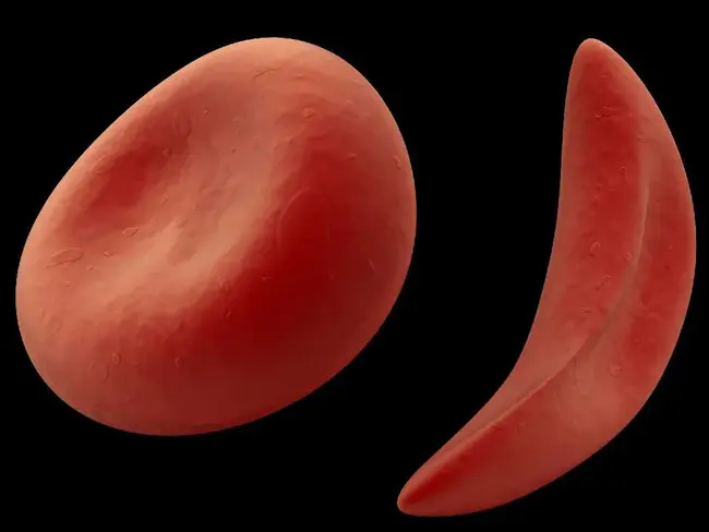 Sickle Haemoglobin : 镰状血红蛋白