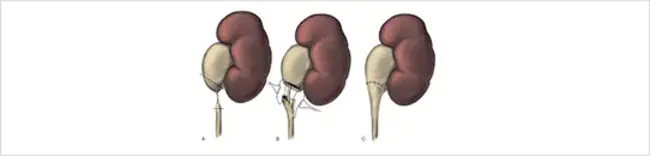 Pelvic-Ureteral Segment : 盆腔输尿管段