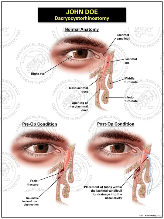 DacryoCystoRhinostomy : 泪囊鼻腔造口术