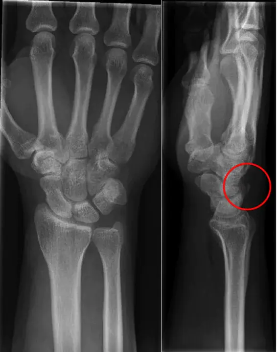 Bone Fracture : 骨折