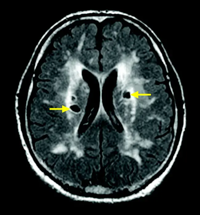 LeukoAraiosis : 脑白质疏松症