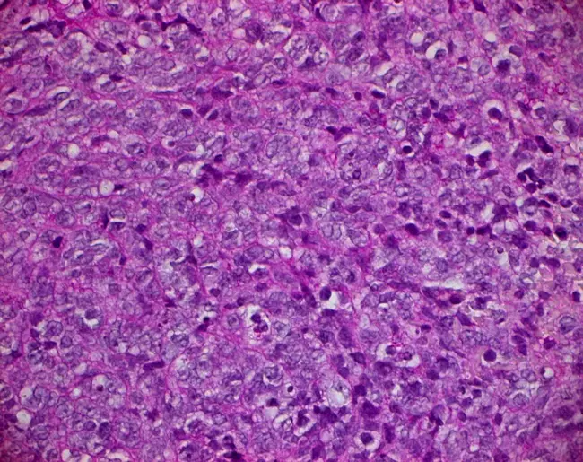 Malignant Fibrous Histiocytoma : 恶性纤维组织细胞瘤