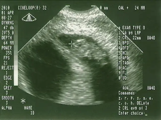 Endoscopic UltraSound-guided fine Needle aspiration biopsy : 内镜超声引导下细针穿刺活检