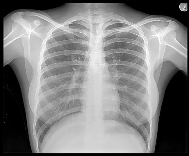 Chest X-Ray : 胸部X光片