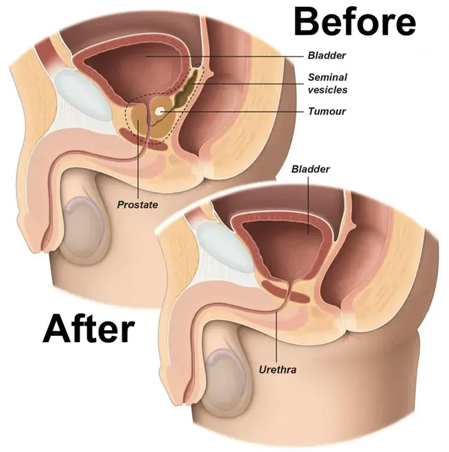 Radical Prostatectomy : 根治性前列腺切除术