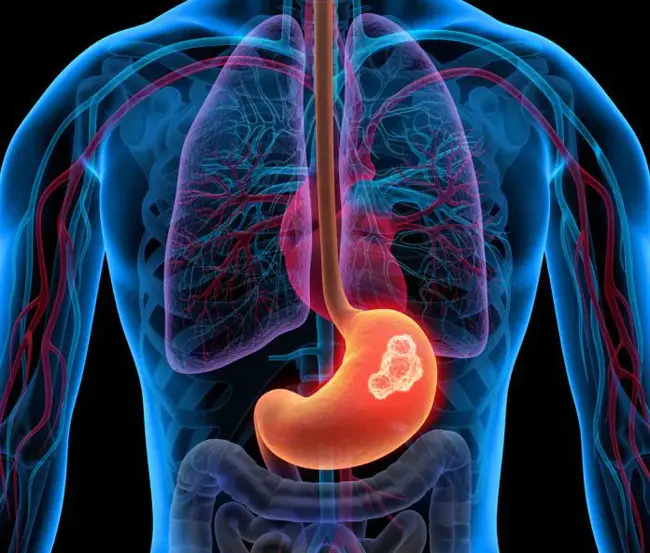 Gastro-Intestinal Stromal Tumor : 胃肠间质瘤