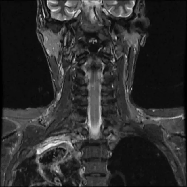 Spinocerebellar Degeneration : 脊髓小脑变性