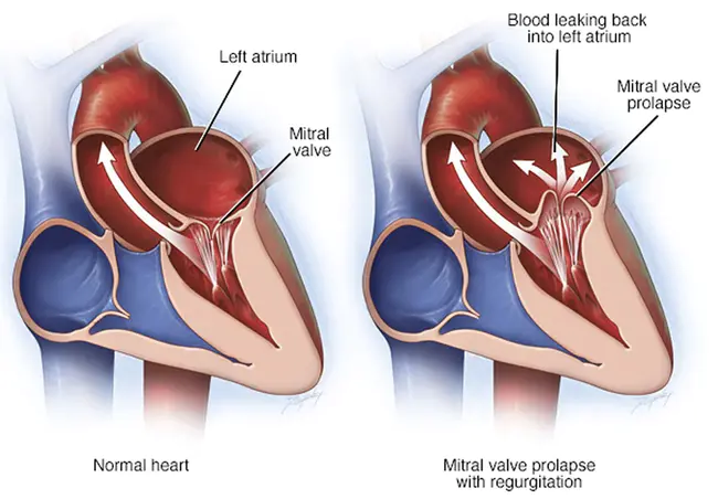 Prolapse of Mitral Valve : 二尖瓣脱垂