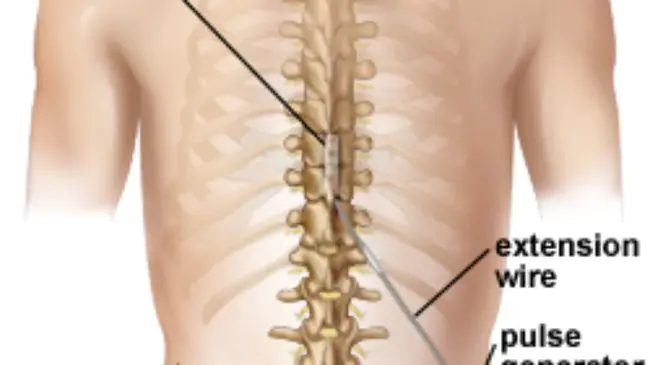 Dorsal Column Stimulation : 背柱刺激