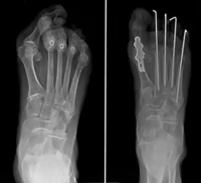 Forefoot Orthosis : 前脚矫形器