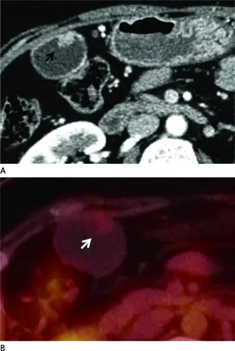 Attenuated Familial Adenomatous Polyposis : 家族性腺瘤性息肉病