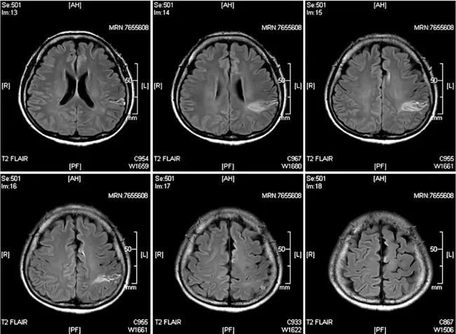 PolyElectroMyoGraphy : 多肌电图