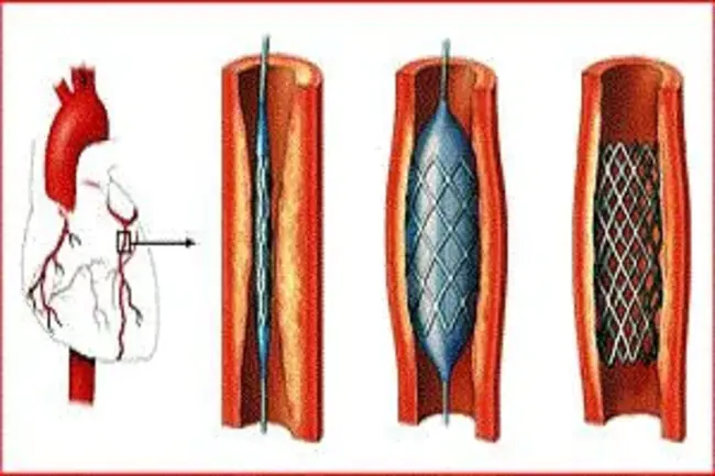 PerCutaneous Transluminal Angioplasty : 经皮腔内血管成形术