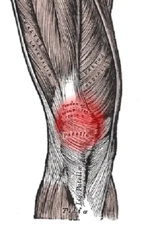 Vertebral Algic Syndrome : 脊椎痛症候群