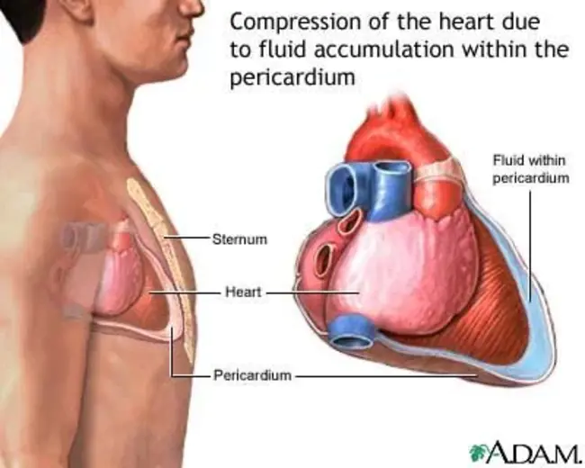 Systolic Ejection Murmur : 收缩期射血杂音