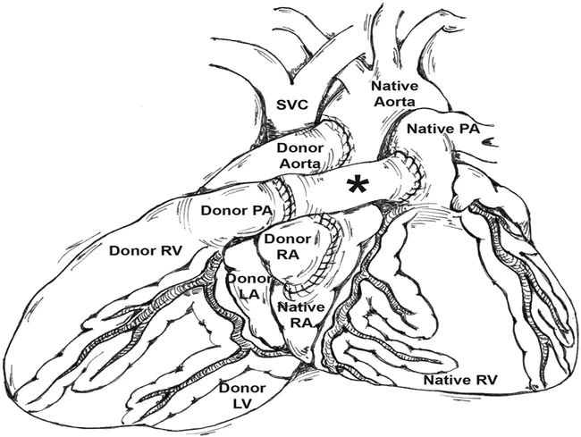 TransOesophageal Echocardiogram : 经食管超声心动图