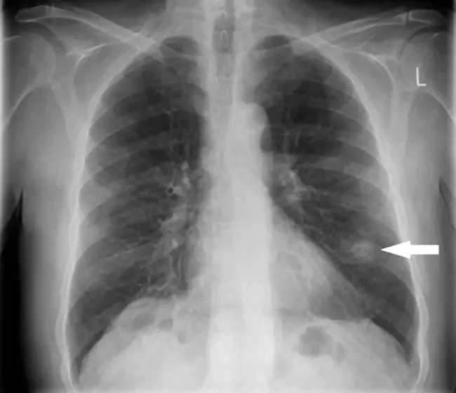 Solitary Pulmonary Nodule : 孤立性肺结节