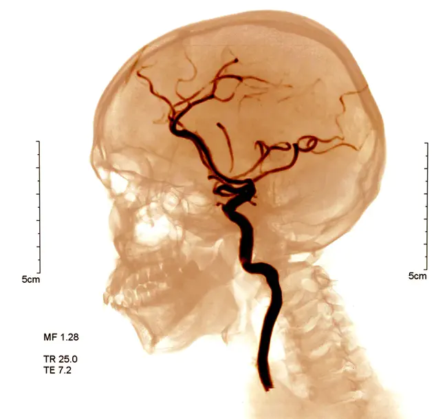 CerebroVascular Infarction : 脑血管梗塞