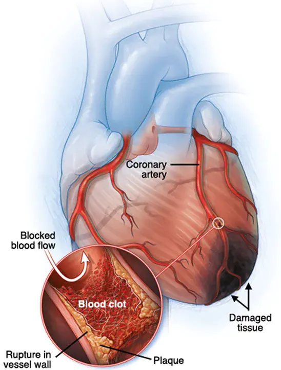 Myocardial Perfusion Imaging : 心肌灌注成像