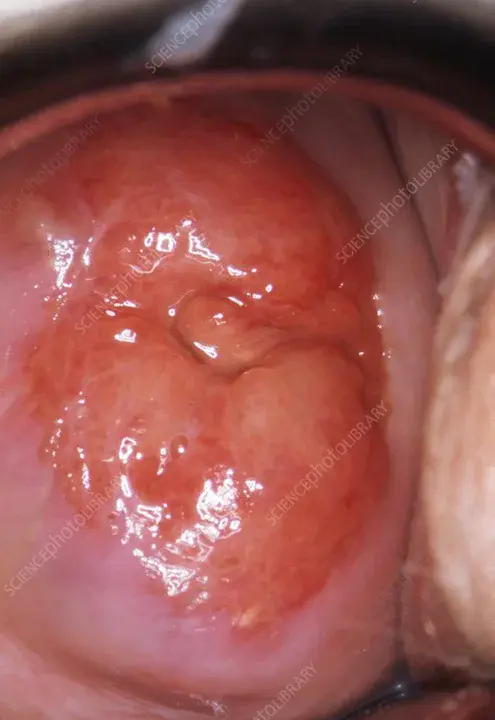 Cervical Intra-epithelial Neoplasia : 宫颈上皮内瘤样病变