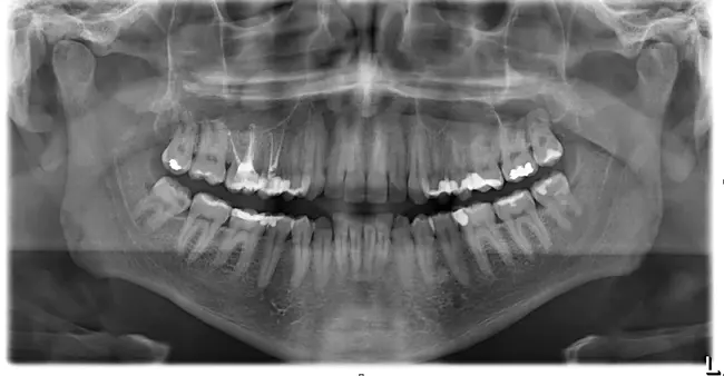 OrthoPantomoGram : 正断层图