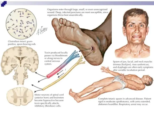 Tetanus ImmunoGlobulin : 破伤风免疫球蛋白